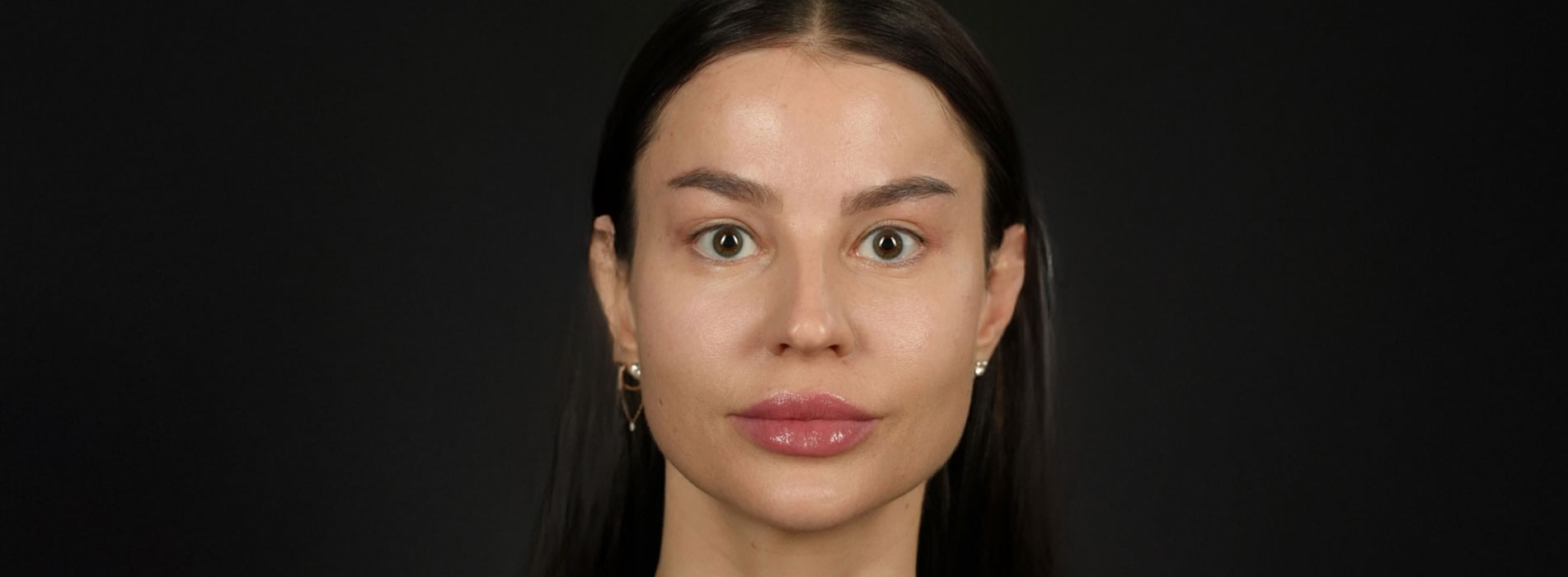 Блефаропластика верхніх повік — результат після процедури, Docber Clinic